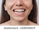 Cropped shot of a young caucasian woman demonstrating perfect white ragged teeth teeth on a white background. Dental health care. Dentistry. Female uneven teeth