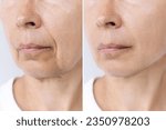 Small photo of Lower part of elderly woman's face and neck with signs of skin aging before after facelift, plastic surgery. Age-related changes, flabby sagging skin, wrinkles, creases. Rejuvenating procedures