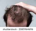 Small photo of Close up of a young man holding his hair back showing clear signs of a receding hairline and hair loss. First stages of male pattern baldness with bald patches and thinning hair.