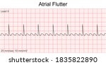 Electrocardiogram Show Atrial...