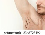 Young man shows irritation on the sensitive skin after using a razor, trimmer, toxic deodorant or antiperspirant. Armpit rash. Allergy, irritation or atopic dermatitis. Acne or red spots underarm
