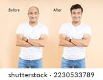 Before and After of hair loss treatment or transplant of a young indian man isolated on beige background.