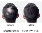 Male head with bald head and bald head. Hair transplantation and extension. Before and after.