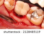 Small photo of Peri-implantitis : Diseases that cause loss of bone around the dental implant, we can see the screw expose and gingival recession