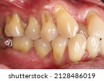 Small photo of Dental cervical abrasion with gingival recession due to hard brushing