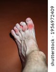 Small photo of a leg with gouty toes, marked in red. toes affected by Gout - a disease in which defective metabolism of uric acid causes arthritis, especially in the smaller bones.