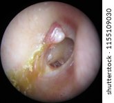 Small photo of chronic suppurative otitis media. tympanic membrane perforation