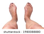 Small photo of Hallux valgus, bunion on elderly woman's feet isolated on white background. Painful toe joint deformity with misalignment of toes. Concept of medical treatment or cosmetology help. Closeup, top view.