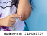 Small photo of Finger of girl point to her elbow because dark patches on the skin and allergic rash known as acanthosis nigricans look like a darkened velvet.