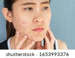 Small photo of Close up of worrying woman with problems of acne inflammation (Papule and Pustule) on her face. Conceptual of problems on woman skin.