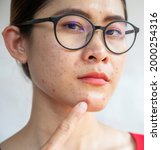 Small photo of Headshot of Asian woman pointing to acne occur on her face. Inflamed acne consists of swelling, redness, and pores that are deeply clogged with bacteria, oil, and dead skin cells.