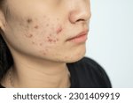 Small photo of Cropped shot of woman having acne inflammation on her cheek. Inflamed acne consists of swelling, redness, and pores that are deeply clogged with bacteria, oil, and dead skin cells.