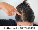 Woman with thin hair caused by hair loss symptoms.