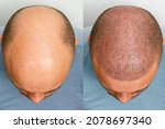 Small photo of The head of a balding man before and after hair transplant surgery. A man losing his hair has become shaggy. An advertising poster for a hair transplant clinic. Treatment of baldness.