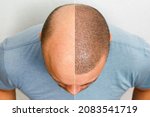 The head of a balding man before and after hair transplant surgery. A man losing his hair has become shaggy. An advertising poster for a hair transplant clinic. Treatment of baldness.