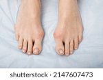 Small photo of The woman suffers from inflammation of the big toe bone. Hallux valgus, bunion in foot on white background.