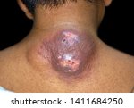 Small photo of Painful carbuncle or large abscess with surrounding cellulitis or Staphylococcal / Streptococcal skin infection of big lipoma in nape or back of Asian Burmese adult male patient in clinic of Myanmar