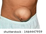 Small photo of Large congenital umbilical hernia protruding from anterior abdominal wall in Asian baby. It is an abnormal bulge that can be seen at the umbilicus (belly button).