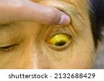 Small photo of Deep jaundice in Asian male patient. Yellowish discoloration of skin and sclera. Hyperbilirubinemia. Acute hepatitis.