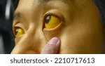 Small photo of Deep jaundice in Asian male patient. Yellowish discoloration of skin and sclera. Hyperbilirubinemia. Acute hepatitis.