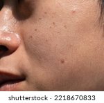 Small photo of Dark spots called age spots and on the face of Asian man. They are also called liver spots, senile lentigo, or sun spots. Closeup view.