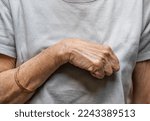 Small photo of Volkmann contracture in left upper limb of Southeast Asianold woman. It is a permanent shortening of forearm muscles that gives rise to a clawlike posture of the hand, fingers, and wrist.
