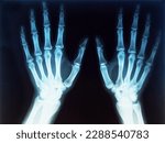 Small photo of X-rayed human hand. X-ray of hand bones. Woman's hands x-rays film. Film x-ray both hand AP, doctor office. Human skeleton.