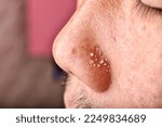 Small photo of Men skin problem, Acne squeeze, Whitehead comedone pus extraction, Close up man face with clogged pores pimple on nose, Scar and oily greasy face, Beauty concept.