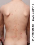 Small photo of Insect bites of a bedbug such as Cimex lectularius or Cimex hemipterus on the child's body after returning from a vacation tourist trip from another city