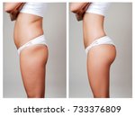 Female body before and after liposuction. Plastic surgery concept.