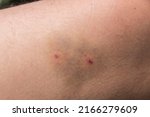 Small photo of Two puncture wounds and bruising on the left inner thigh caused by accidental dog bite. Light injury caused by medium sized canine teeth.