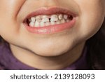 Small photo of The child shows teeth with hypoplasia. Pediatric dentistry and periodontology, bite correction. Health and dental care, caries treatment, baby teeth. Dark spots on teeth