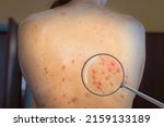 Monkeypox Infection Virus On A...