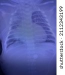 Small photo of string appearance the heart shape of patient who have TGA transposition of the great artery with pneumonia pulmonary congestion , dilated stomach bowel ileus