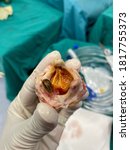 Small photo of Closeup view of bioprosthetic heart valve dysfunction in patient who has mitral valve replacement with tissue valve.