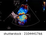 Small photo of Echocardiography image show mitral valve stenosis