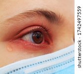 Small photo of A girl in a protective medical mask. Close-up of a reddened, watery eye. Spring allergy concept.