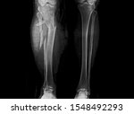 Small photo of Leg X-ray showing severe open comminuted fracture of proximal tibia and fibula. The patient also has compartment syndrome. The patient needs emergent fasciotomy and external fixation.