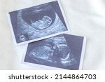 Small photo of ultrasound pictures shows different gestational periods. sonogram of fetus, unborn yet baby, on white textile surface and blue heart means it's a baby boy. toy for teeth and white cotton bib. flat lay