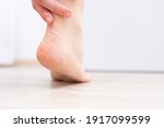 The dry skin on the heel is cracked. Treatment concept with moisturizing creams and exfoliation for healing wounds and pain when walking. Dehydrated skin on the heels of female feet
