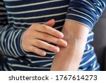 Small photo of Female hands applying ointment on crook of arm / elbow. Apply a soothing cream in the treatment and hydration of red itchy skin. Concept of skincare, eczema, allergy rash and other skin disease