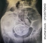Small photo of "Stone in abdomen" or Calcified uterine leiomyoma . Calcification of uterus. Calcify uterine fibroid in abdomen radiograph. Medical and healthcare shot.