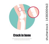 bone fracture type of fracture. ... | Shutterstock .eps vector #1438300463