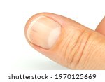 Thumb Fingernail With Sliver....