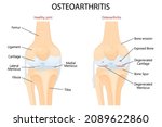 knee osteoarthritis and normal... | Shutterstock .eps vector #2089622860