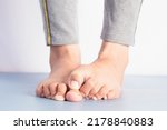 Small photo of Foot fungus, close-up of an itchy woman scratching her toes with her big toes.