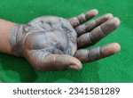 Small photo of March 08, 2023; Layyah, Punjab, Pakistan: A patient with scald burn of right hand with blister formation. It was caused by accidental spillage of boiling milk.