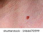 Small photo of Benign skin lesion, pigmented naevus, inborn mole. Health concept