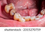 Tooth decay  broken teeth  oral ...