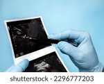 Small photo of A urologist doctor carefully analyzes a stone disease, an ultrasound of a person’s kidneys on an x-ray, a stone or a calculus in the kidney on an ultrasound in the doctor’s hands. Male urinary tract